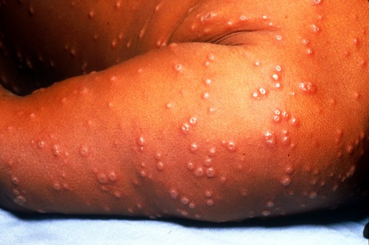 smallpox